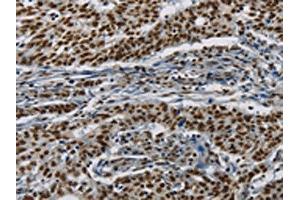 The image on the left is immunohistochemistry of paraffin-embedded Human gastic cancer tissue using ABIN7190953(HIST1H2AB Antibody) at dilution 1/20, on the right is treated with synthetic peptide.