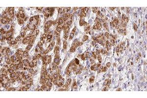 ABIN6278185 at 1/100 staining Human liver cancer tissue by IHC-P. (PNPLA2 anticorps  (Internal Region))