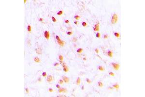 Immunohistochemical analysis of CTBP1 staining in human lung cancer formalin fixed paraffin embedded tissue section.