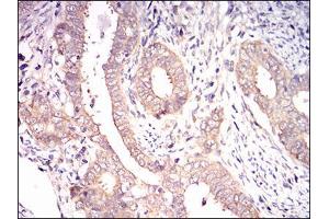 Immunohistochemical analysis of paraffin-embedded cervical cancer tissues using EIF2A mouse mAb with DAB staining.