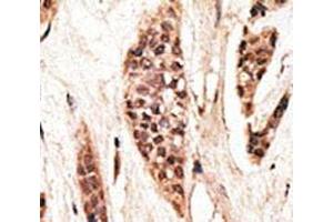 IHC analysis of FFPE human breast carcinoma tissue stained with the TAP1 antibody