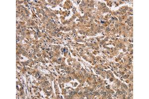 Immunohistochemistry of Human liver cancer using KCNG2 Polyclonal Antibody at dilution of 1:40 (Kcng2 anticorps)
