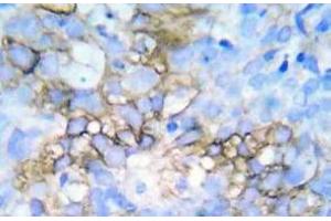 Immunohistochemistry (IHC) analyzes of p-HSP27 antibody in paraffin-embedded human breast carcinoma tissue. (HSP27 anticorps  (pSer78, pSer82))