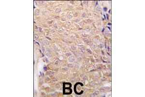 Formalin-fixed and paraffin-embedded human breast carcinoma tissue reacted with ALDH6A1 polyclonal antibody  , which was peroxidase-conjugated to the secondary antibody, followed by DAB staining. (ALDH6A1 anticorps  (N-Term))