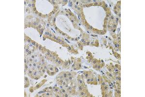 Immunohistochemistry of paraffin-embedded human thyroid cancer using NCF4 Antibody (ABIN5971122) at dilution of 1/100 (40x lens). (NCF4 anticorps)
