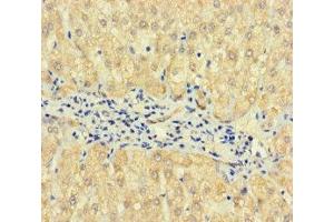 Immunohistochemistry of paraffin-embedded human liver cancer using ABIN7163173 at dilution of 1:100 (TPTE2 anticorps  (AA 167-411))