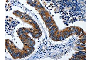 The image on the left is immunohistochemistry of paraffin-embedded Human colon cancer tissue using ABIN7191255(LAMA1 Antibody) at dilution 1/25, on the right is treated with synthetic peptide. (Laminin alpha 1 anticorps)