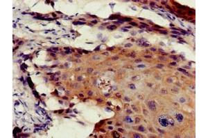 Immunohistochemistry of paraffin-embedded human cervical cancer using ABIN7172545 at dilution of 1:100 (ETV7 anticorps  (AA 134-218))