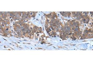 Immunohistochemistry of paraffin-embedded Human thyroid cancer tissue using CNTN1 Polyclonal Antibody at dilution of 1:35(x200)