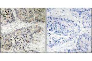 Immunohistochemistry analysis of paraffin-embedded human lung carcinoma, using MAPK15 Antibody. (MAPK15 anticorps  (AA 361-410))