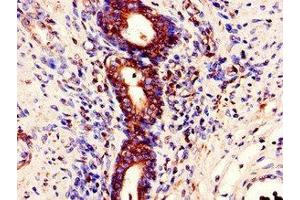 Immunohistochemistry of paraffin-embedded human prostate cancer using ABIN7150628 at dilution of 1:100