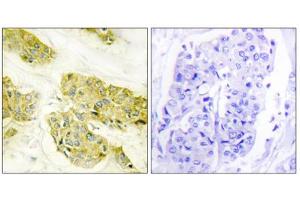 Immunohistochemistry analysis of paraffin-embedded human breast carcinoma tissue using COL5A3 antibody. (COL5A3 anticorps  (N-Term))