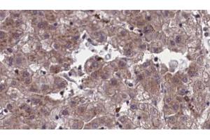 ABIN6273956 at 1/100 staining Human liver cancer tissue by IHC-P. (OR4C45 anticorps)