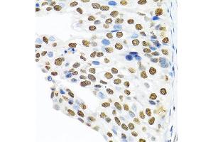 Immunohistochemistry of paraffin-embedded human prostate cancer using PTBP1 antibody at dilution of 1:100 (40x lens).