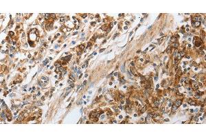 Immunohistochemistry of paraffin-embedded Human gastic cancer using NPY1R Polyclonal Antibody at dilution of 1:30 (NPY1R anticorps)