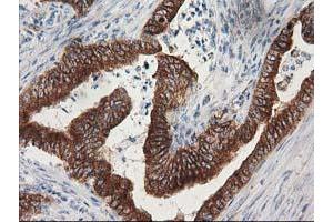 Immunohistochemical staining of paraffin-embedded Adenocarcinoma of Human colon tissue using anti-TUBB4 mouse monoclonal antibody. (TUBB4 anticorps)