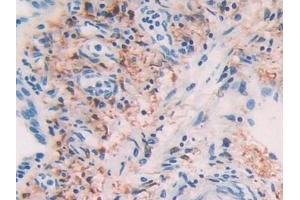 Detection of ADH1 in Human Lung cancer Tissue using Polyclonal Antibody to Alcohol Dehydrogenase 1 (ADH1)