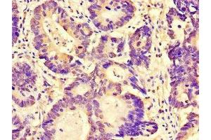Immunohistochemistry of paraffin-embedded human colon cancer using ABIN7165414 at dilution of 1:100 (FAM151B anticorps  (AA 1-276))
