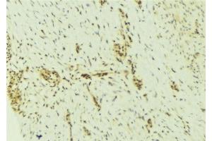 ABIN6276929 at 1/100 staining Human breast cancer tissue by IHC-P. (DKC1 anticorps  (Internal Region))