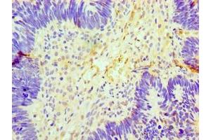Immunohistochemistry of paraffin-embedded human ovarian cancer using ABIN7153892 at dilution of 1:100