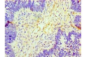 Immunohistochemistry of paraffin-embedded human ovarian cancer using ABIN7153892 at dilution of 1:100 (GCKR anticorps  (AA 1-625))