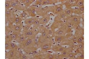 IHC image of ABIN7139992 diluted at 1:200 and staining in paraffin-embedded human liver cancer performed on a Leica BondTM system. (OR4C15 anticorps  (AA 258-268))