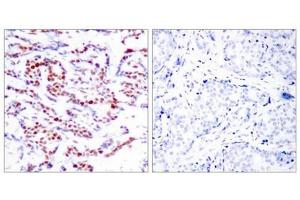 Immunohistochemical analysis of paraffin-embedded human breast carcinoma tissue using ATF2(Phospho-Ser112 or 94) Antibody(left) or the same antibody preincubated with blocking peptide(right).