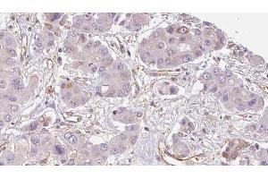 ABIN6273934 at 1/100 staining Human liver cancer tissue by IHC-P. (GPR33 anticorps  (Internal Region))