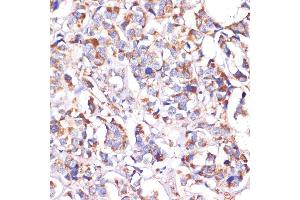 Immunohistochemistry of paraffin-embedded human breast cancer using STOML2 antibody (ABIN6132693, ABIN6148629, ABIN6148630 and ABIN6214642) at dilution of 1:100 (40x lens). (STOML2 anticorps  (AA 29-356))