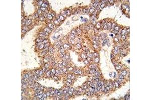 IHC analysis of FFPE human prostate carcinoma tissue stained with TRPM8 antibody