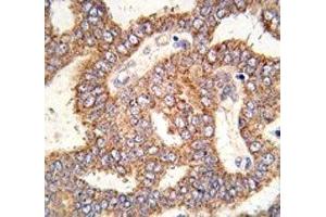 IHC analysis of FFPE human prostate carcinoma tissue stained with TRPM8 antibody (TRPM8 anticorps  (AA 1075-1104))