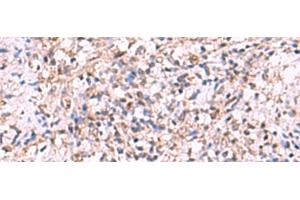 Immunohistochemistry of paraffin-embedded Human cervical cancer tissue using LMCD1 Polyclonal Antibody at dilution of 1:100(x200)