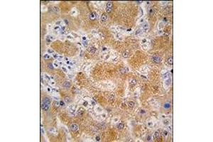 Formalin-fixed and paraffin-embedded human hepatocarcinoma tissue reacted with APOA4 antibody (N-term), which was peroxidase-conjugated to the secondary antibody, followed by DAB staining. (APOA4 anticorps  (C-Term, N-Term))