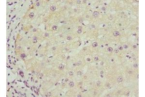 Immunohistochemistry of paraffin-embedded human liver cancer using ABIN7145588 at dilution of 1:100 (BAAT anticorps  (AA 309-418))