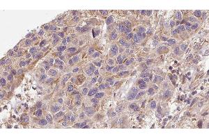 ABIN6276326 at 1/100 staining Human Melanoma tissue by IHC-P. (Midkine anticorps  (Internal Region))