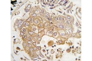 IHC analysis of FFPE human lung carcinoma tissue stained with CYP1A1 antibody (CYP1A1 anticorps  (AA 377-405))