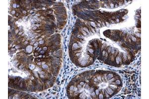 IHC-P Image mtTFA antibody detects mtTFA protein at cytoplasm in human colon cancer by immunohistochemical analysis.