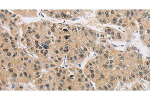 Immunohistochemistry of paraffin-embedded Human liver cancer tissue using AMZ2 Polyclonal Antibody at dilution 1:40 (AMZ2 anticorps)