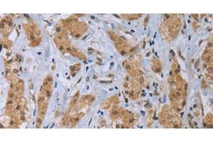 Immunohistochemistry of paraffin-embedded Human breast cancer tissue using CLEC1A Polyclonal Antibody at dilution 1:40 (CLEC1A anticorps)