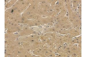 TRAM1 Mouse Monoclonal Antibody at 1/100 staining human liver cancer by IHC-P.