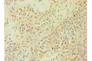 Immunohistochemistry of paraffin-embedded human breast cancer using ABIN7146925 at dilution of 1:100 (Caspase 1 anticorps  (AA 120-269))
