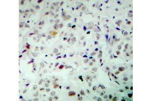 Immunohistochemistry (IHC) image for anti-Retinoblastoma 1 (RB1) (pSer780) antibody (ABIN1681996) (Retinoblastoma 1 anticorps  (pSer780))