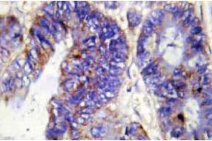 Immunohistochemistry (IHC) analyzes of COL4A2 antibody in paraffin-embedded human colon carcinoma tissue. (COL4a2 anticorps  (Chain alpha 2))