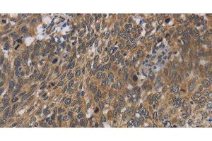 Immunohistochemistry of paraffin-embedded Human cervical cancer using Cytochrome b5 Polyclonal Antibody at dilution of 1:40