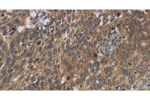 Immunohistochemistry of paraffin-embedded Human cervical cancer using Cytochrome b5 Polyclonal Antibody at dilution of 1:40 (Cytochrome b5 (CYTB5) anticorps)
