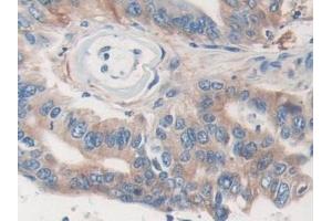 Detection of MVP in Human Colorectal cancer Tissue using Polyclonal Antibody to Major Vault Protein (MVP)