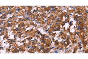 Immunohistochemistry of paraffin-embedded Human thyroid cancer tissue using KIR2DL1/3/4/S4 Polyclonal Antibody at dilution 1:30 (KIR2DL1/3/4/S4 anticorps)