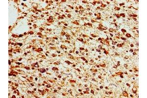 Immunohistochemistry of paraffin-embedded human glioma using ABIN7172611 at dilution of 1:100 (SOX17 anticorps  (AA 177-414))
