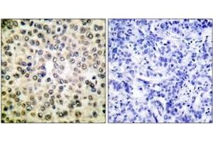 Immunohistochemistry analysis of paraffin-embedded human breast carcinoma tissue, using NF-kappaB p65 (Ab-310) Antibody.
