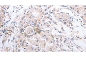 Immunohistochemistry of paraffin-embedded Human lung cancer using MMP11 Polyclonal Antibody at dilution of 1:40 (MMP11 anticorps)